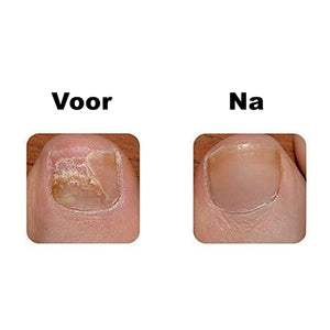 De Anti Kalknagel en Schimmelnagel Thuis Laser